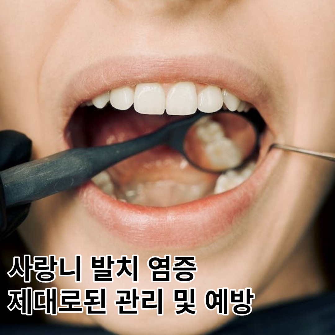사랑니 발치 염증 관리 및 예방, 심한 경우 건성 치조 일 수도