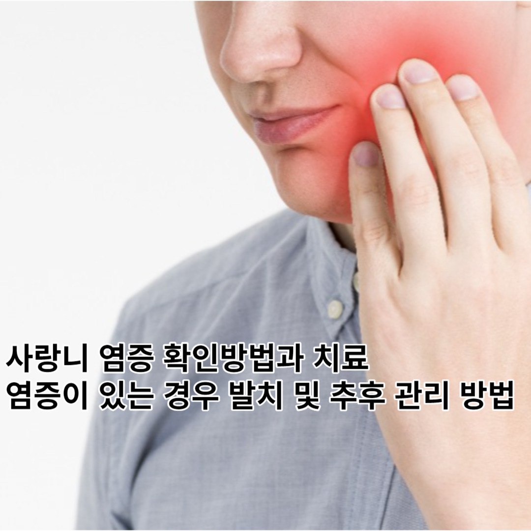 사랑니 염증 확인 방법 및 치료, 염증이 있는 경우 발치와 추후 관리는 어떻게?
