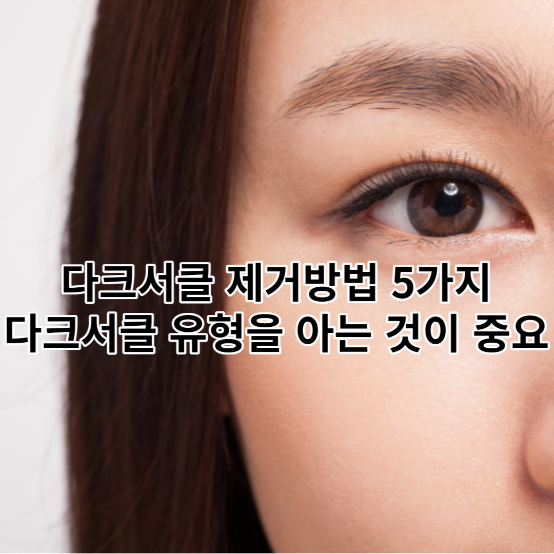다크서클 제거방법 5가지, 어떤 다크서클 유형에 속하는지 아는 것이 중요.